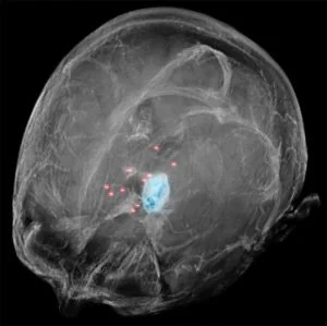 3D brain rendering showing the MRI-detected tumour volume