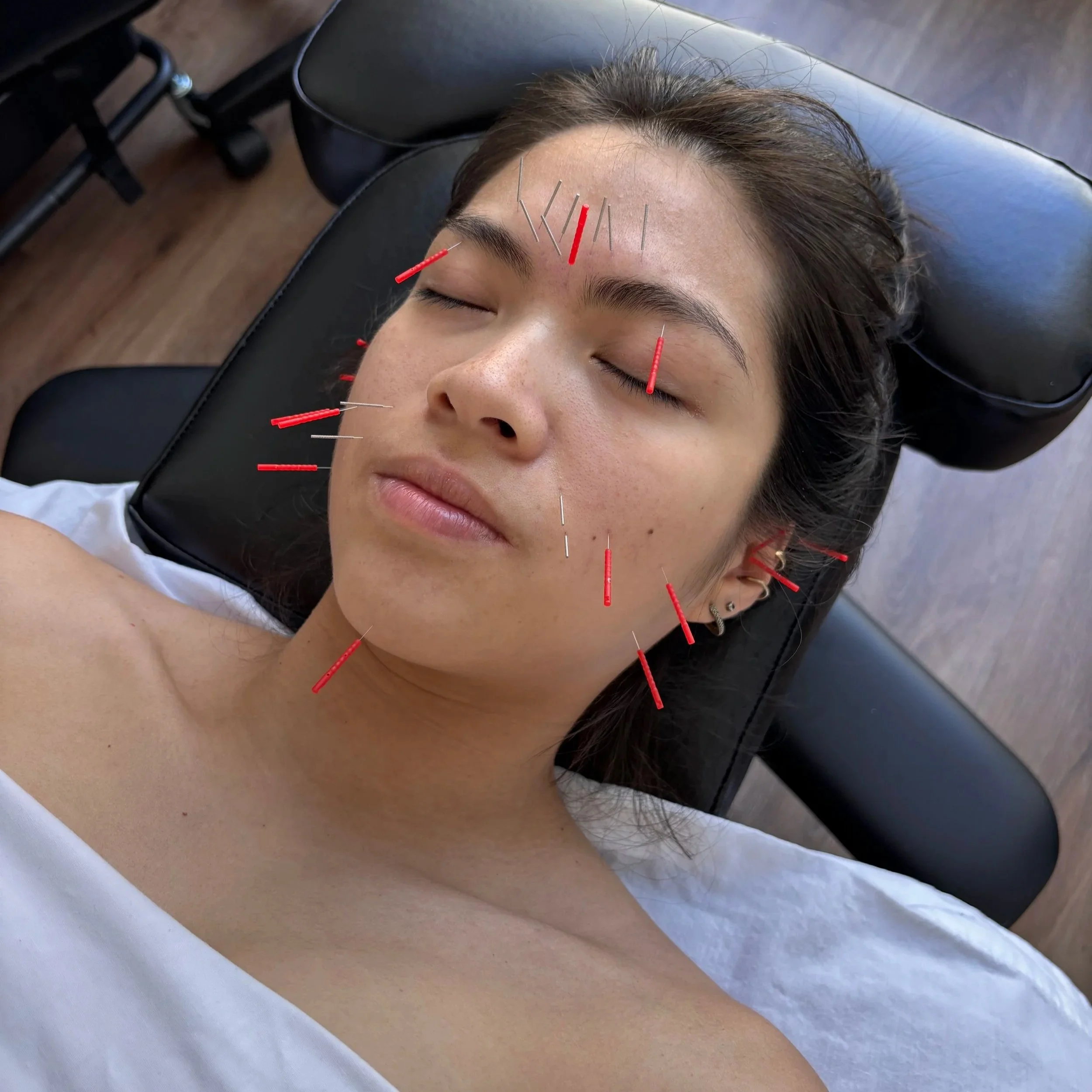 A person receiving acupuncture treatment on their forehead and face, lying on a black treatment table with acupuncture needles inserted at various points.
