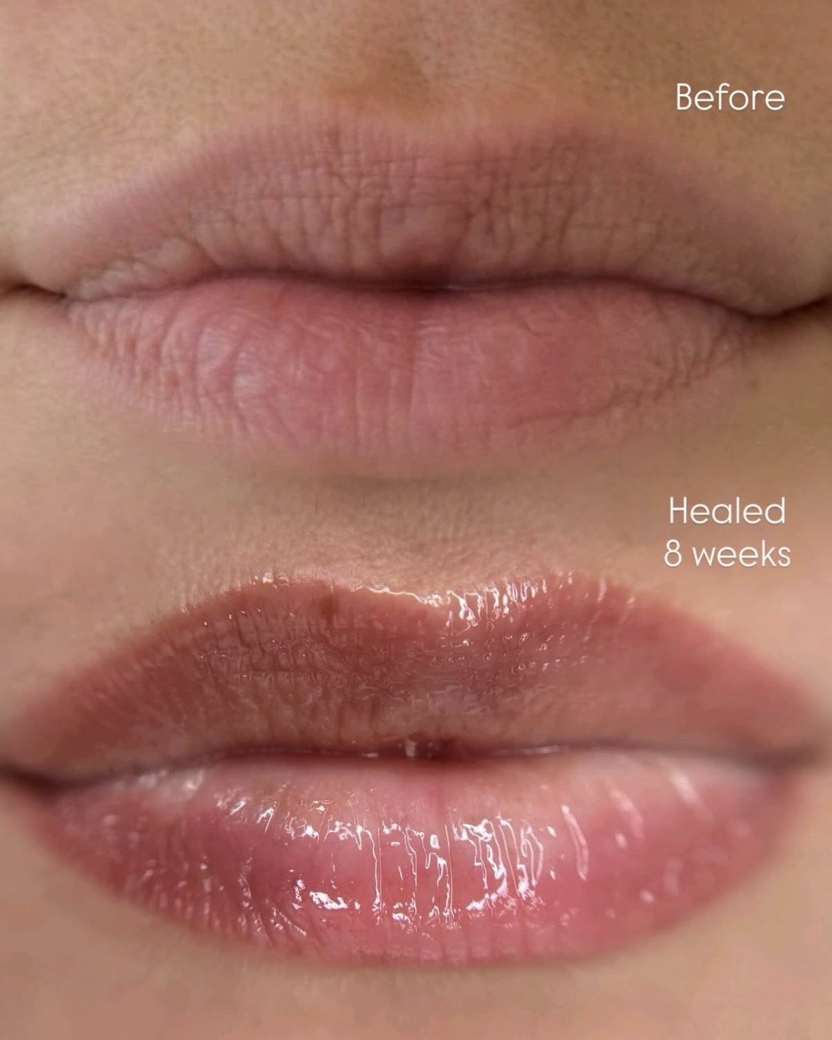 Close-up of lips showing before and healed 8 weeks after treatment, with the top lip labeled 'Before' and the bottom lip labeled 'Healed 8 weeks'.