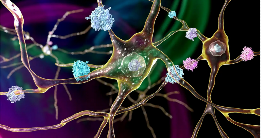 CME Online Activity: Huntington's Disease