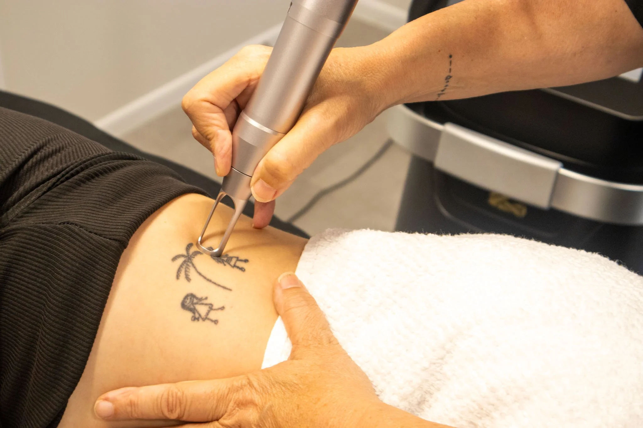 Registered nurse performing laser tattoo removal treatment at Rewind Laser Clinic in Cambridge New Zealand