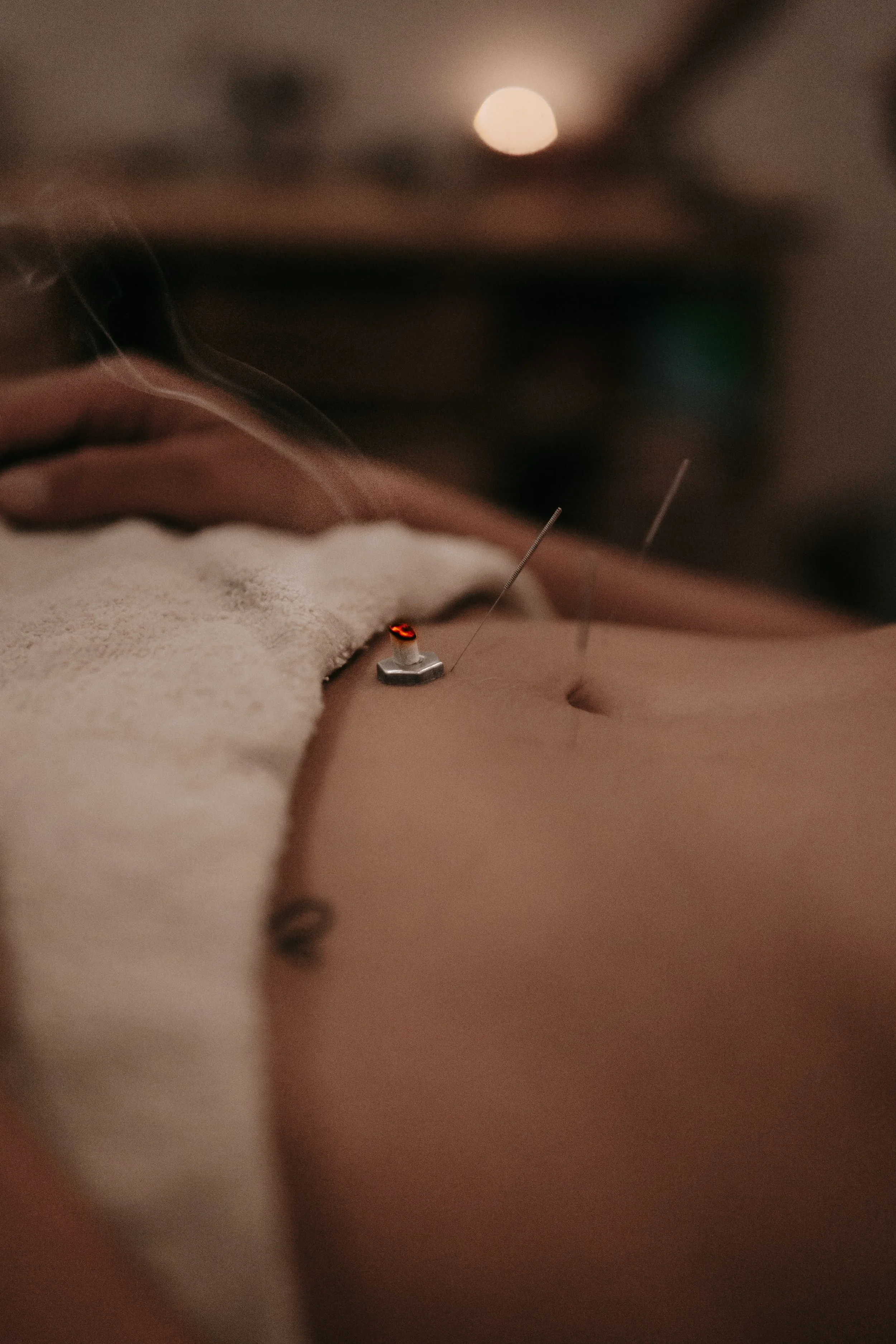 Close-up of a person's back receiving acupuncture treatment, with acupuncture needles inserted into their skin and a glowing red light on one needle, in a dimly lit room with a bright light or moon in the background.