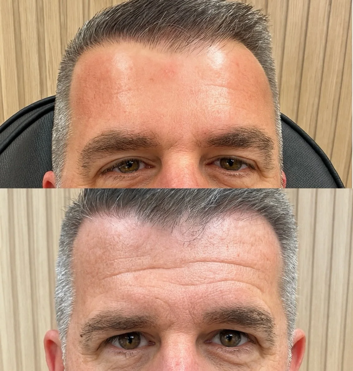 This is what consistency gets you 👏 Our client committed to regular treatments, and the results speak for themselves 

#botox #medspa #sandiegobotox #menbotox #menscare