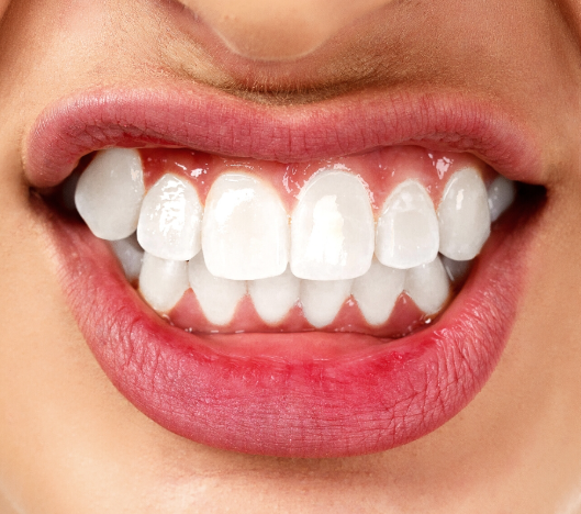 Bruxismo: por qué aprietas los dientes y qué hacer cuando el dolor aparece