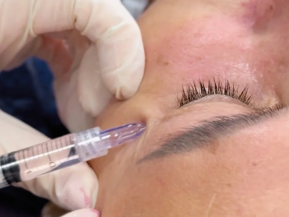 Botoks? Kwas? Nie! Ja chcę naturalnie! – PRP i PRF jako alternatywa w medycynie estetycznej