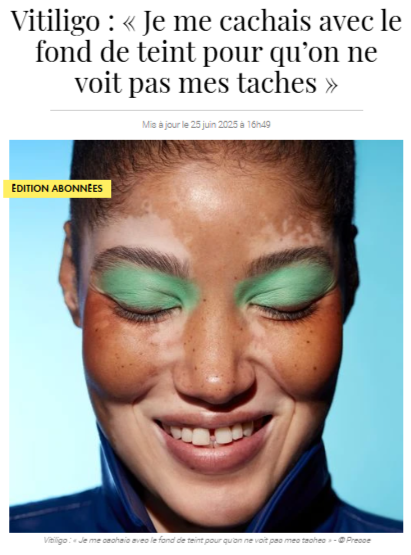 Témoignage d'une mannequin atteinte de vitiligo - publié dans ELLE.