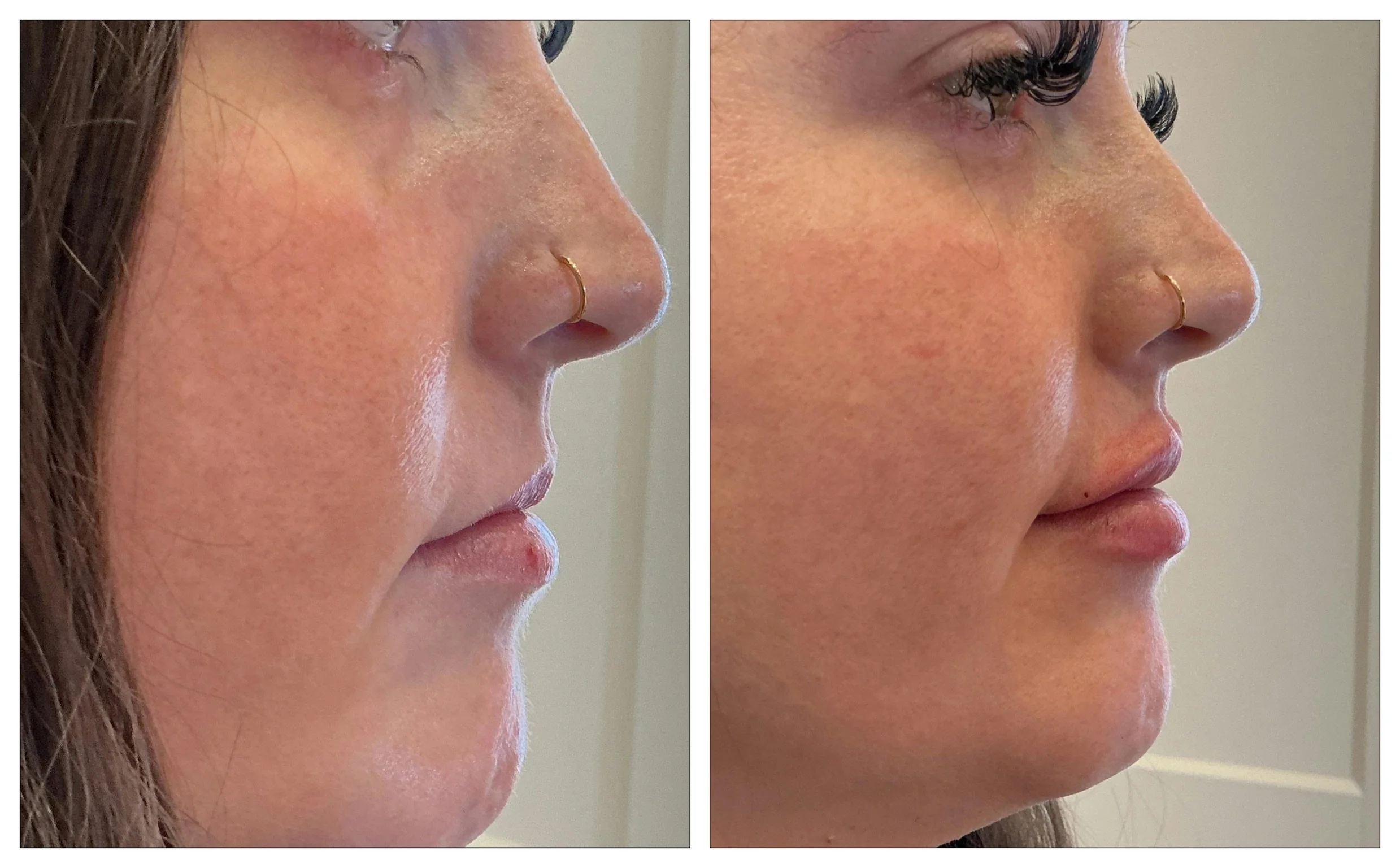 Lip Filler in Omaha: Cost, Results, and What to Expect