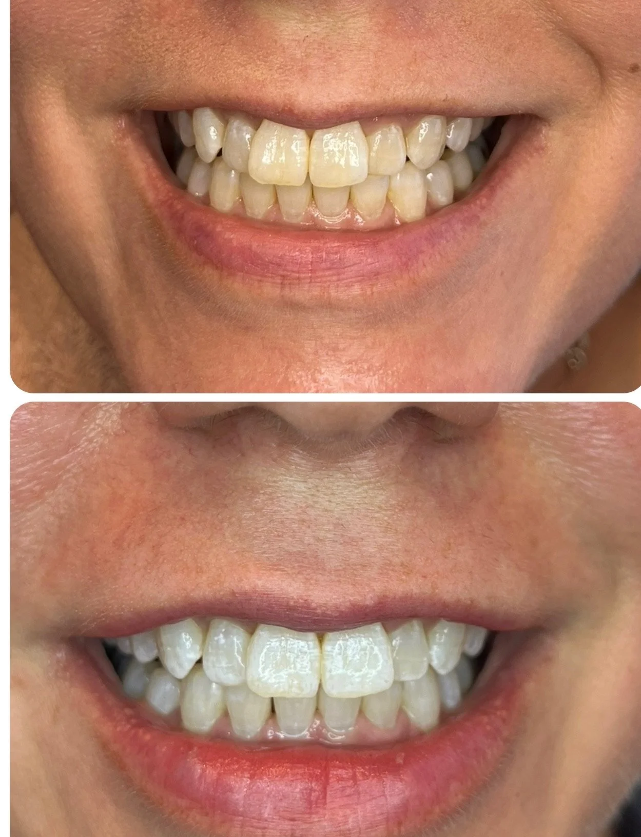 Close-up of a smiling person's mouth showing teeth before and after dental whitening.