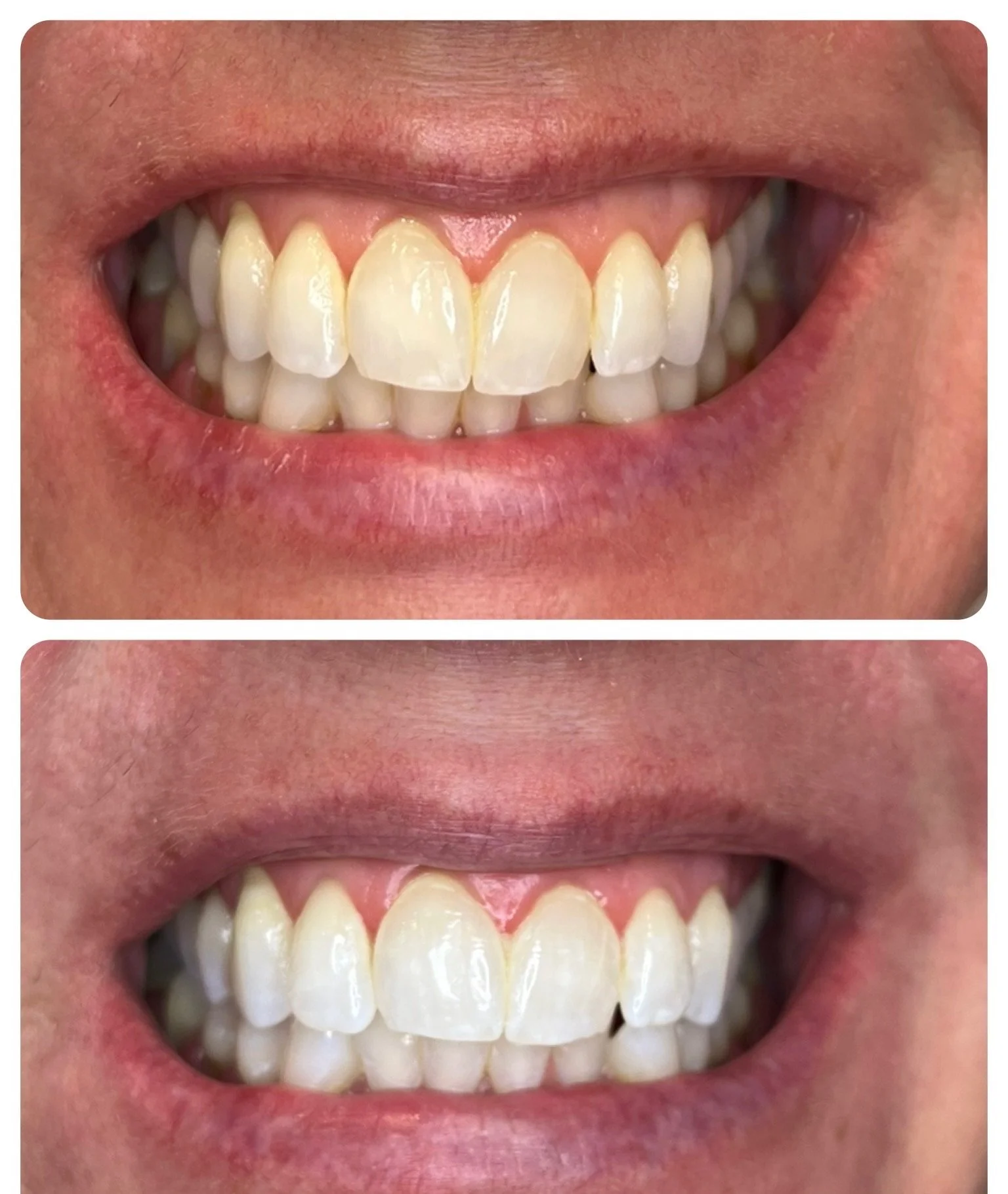 Close-up of a person's smiling mouth showing teeth before and after dental whitening treatment.