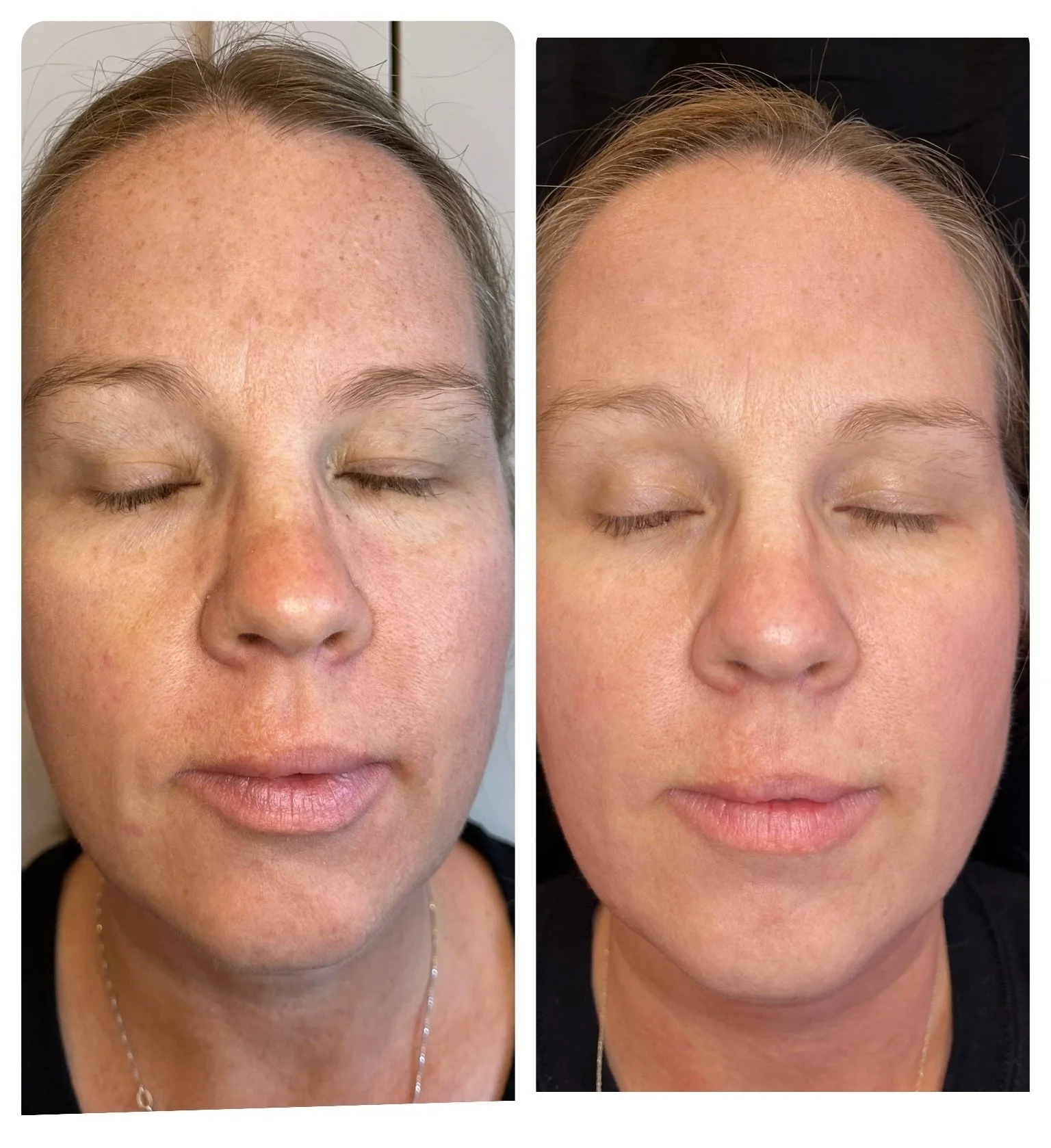 Side-by-side comparison of a woman's face before and after skincare or cosmetic treatment, with close-up focus on forehead, cheeks, and nose, both with eyes closed.