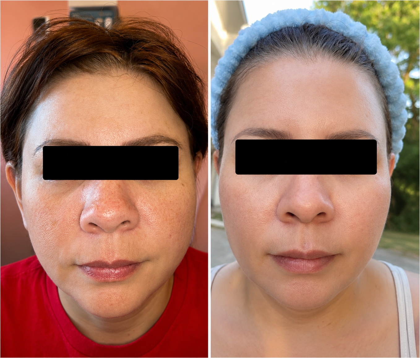 Side-by-side comparison of two close-up portraits of a woman before and after a skincare treatment. The left image shows her with visible skin redness and uneven texture, wearing a red top. The right image shows her with clearer, smoother skin, wearing a light-colored top and a blue headband, outdoors with trees in the background.