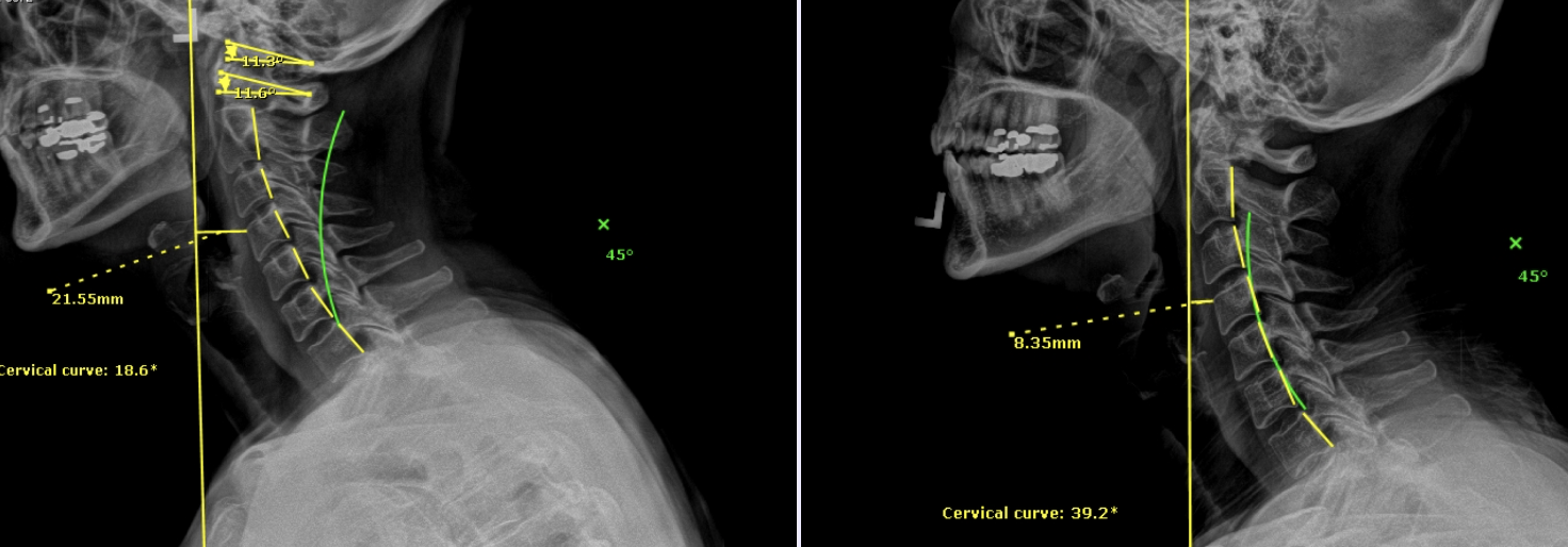 Tammie’s Success with Migraines + Headaches