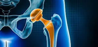 Waiting for Orthopaedic Surgery: What Can You Do in the Meantime?