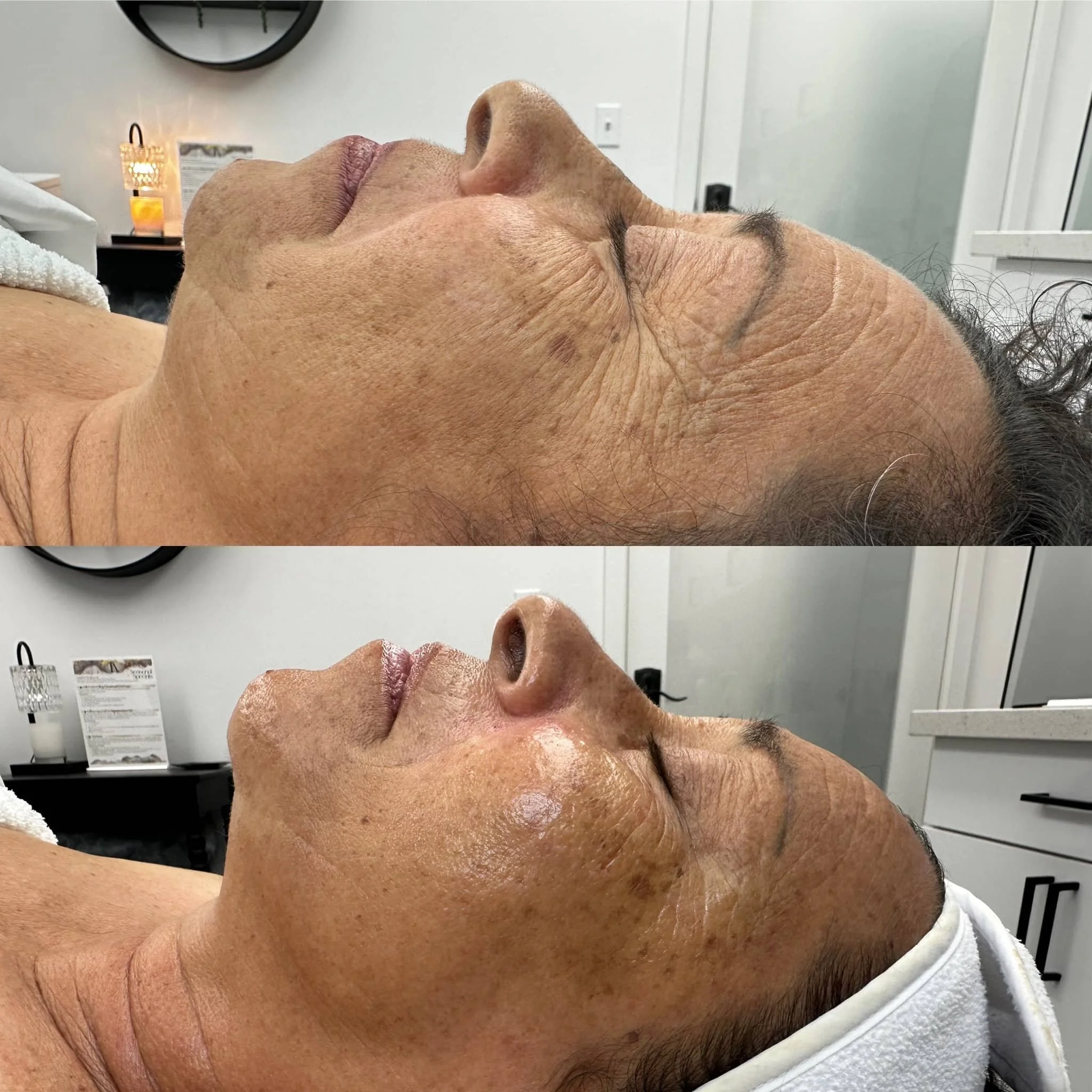Before and after images of a woman's face showing skin treatment results, with smoother skin and reduced wrinkles in the after photo.