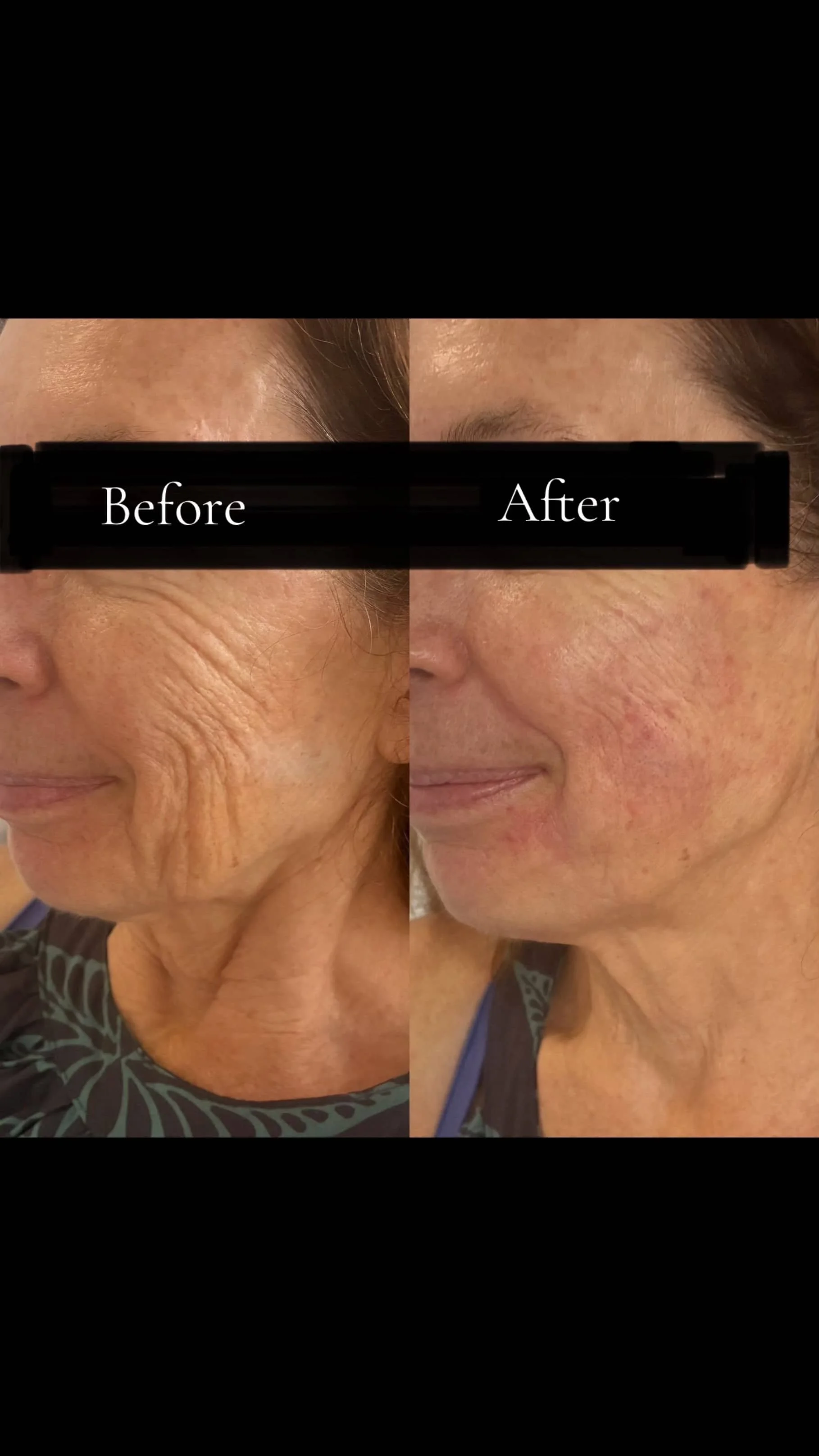 Side-by-side comparison of a woman's face before and after skin treatment, showing reduced wrinkles and improved skin texture.