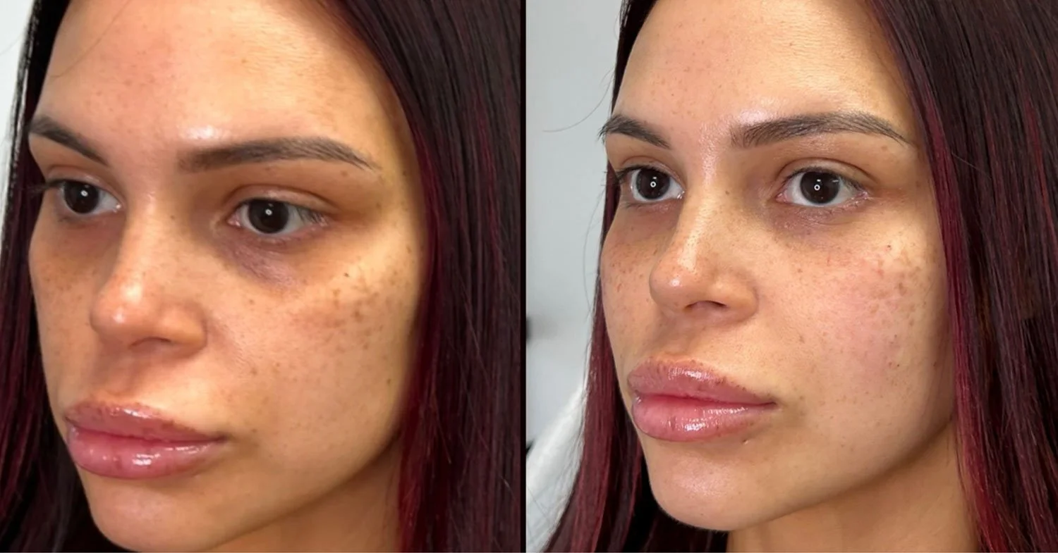 What Is PRF? Why Clients Are Choosing It Over Traditional Filler