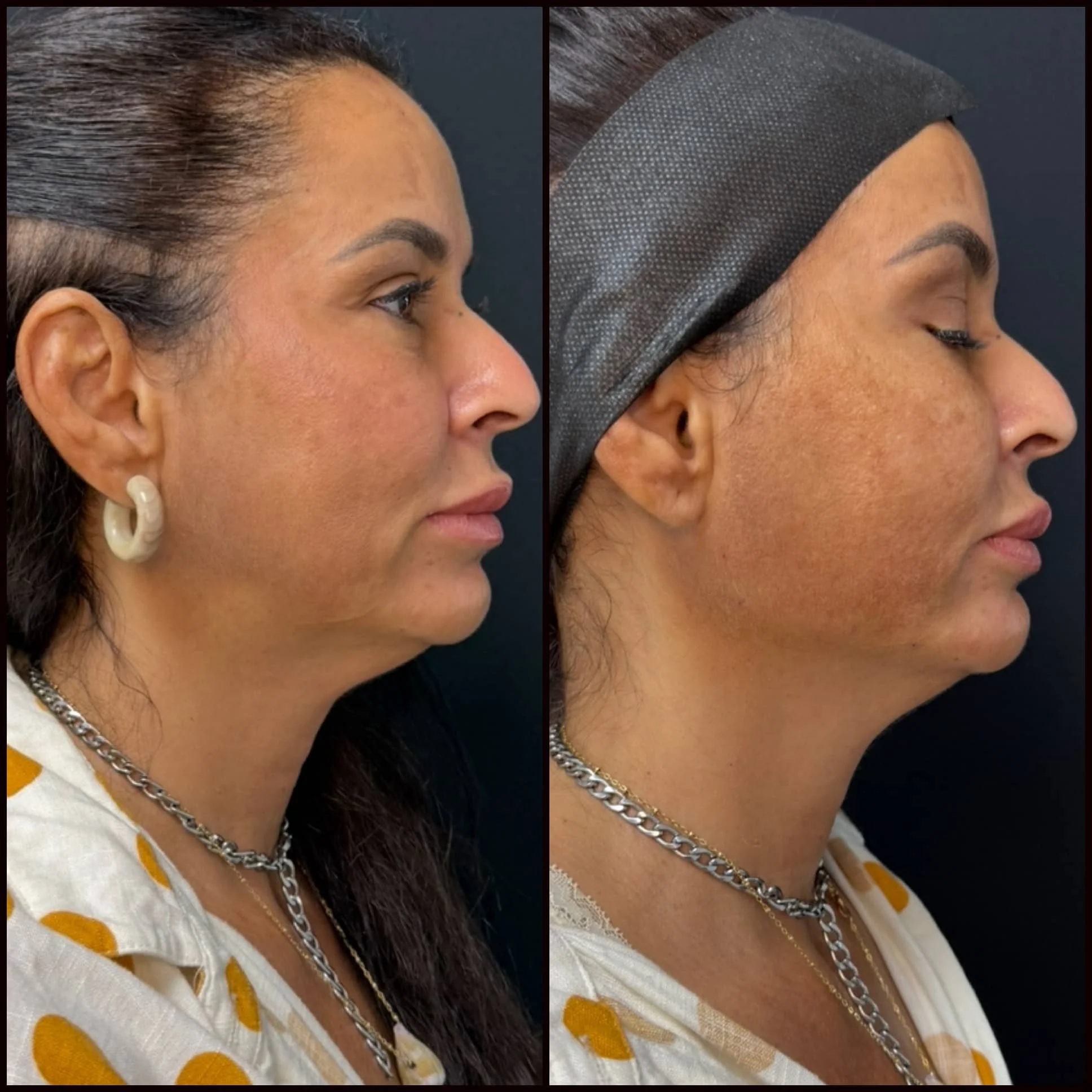Side-by-side comparison of a woman's profile before and after a cosmetic treatment, showing skin improvements.