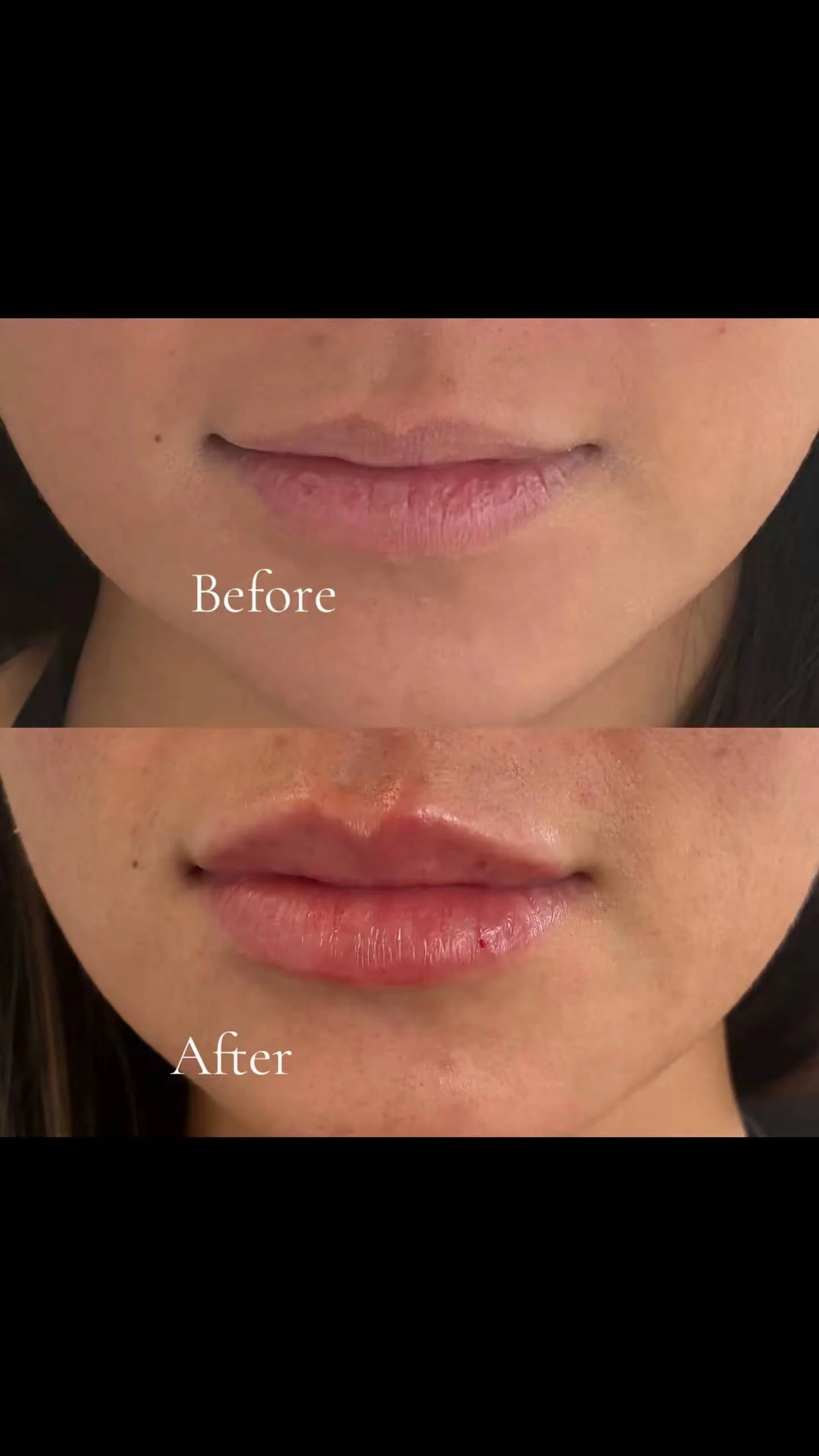 Close-up of a person's lips before and after a cosmetic procedure, with the 'before' showing dry lips and the 'after' showing slightly swollen, more moisturized lips with some minor bleeding.