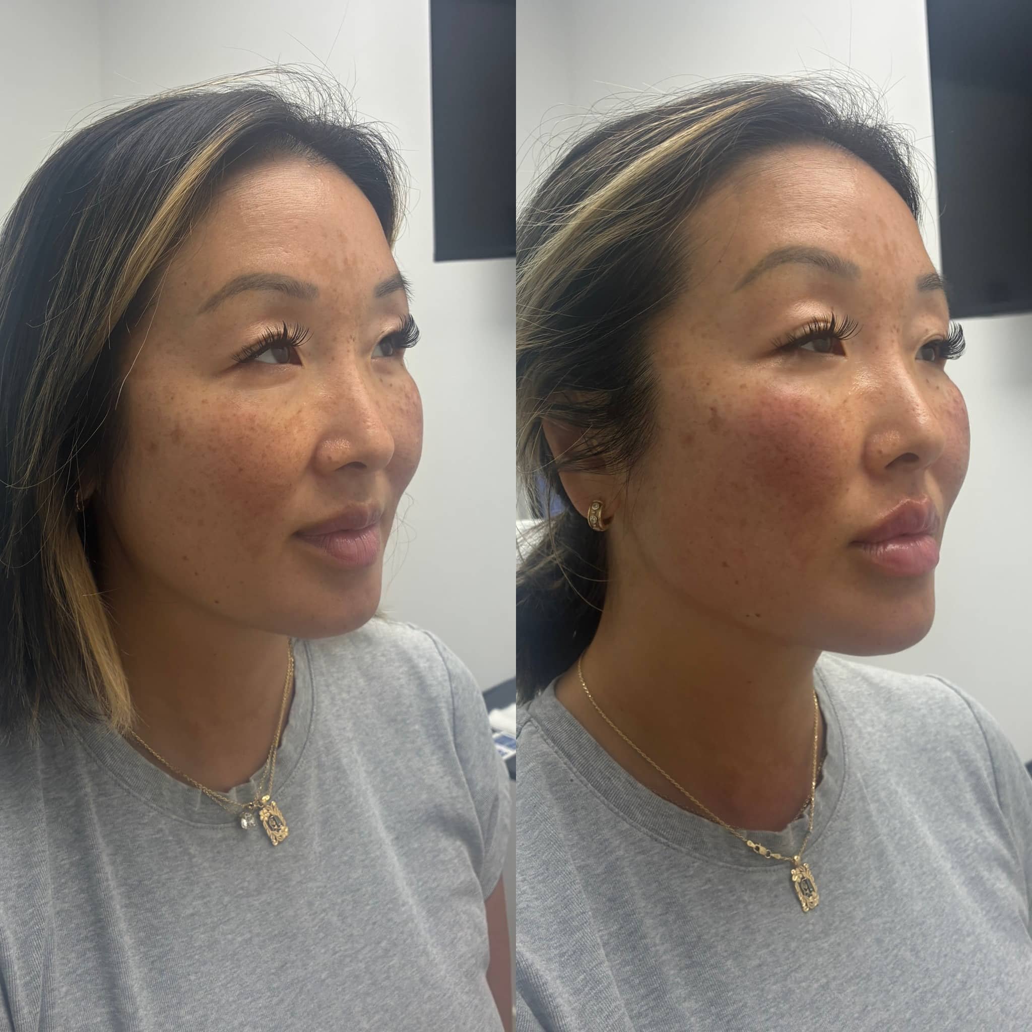 Side-by-side comparison of a woman with clear skin and freckles before and after skincare treatment.