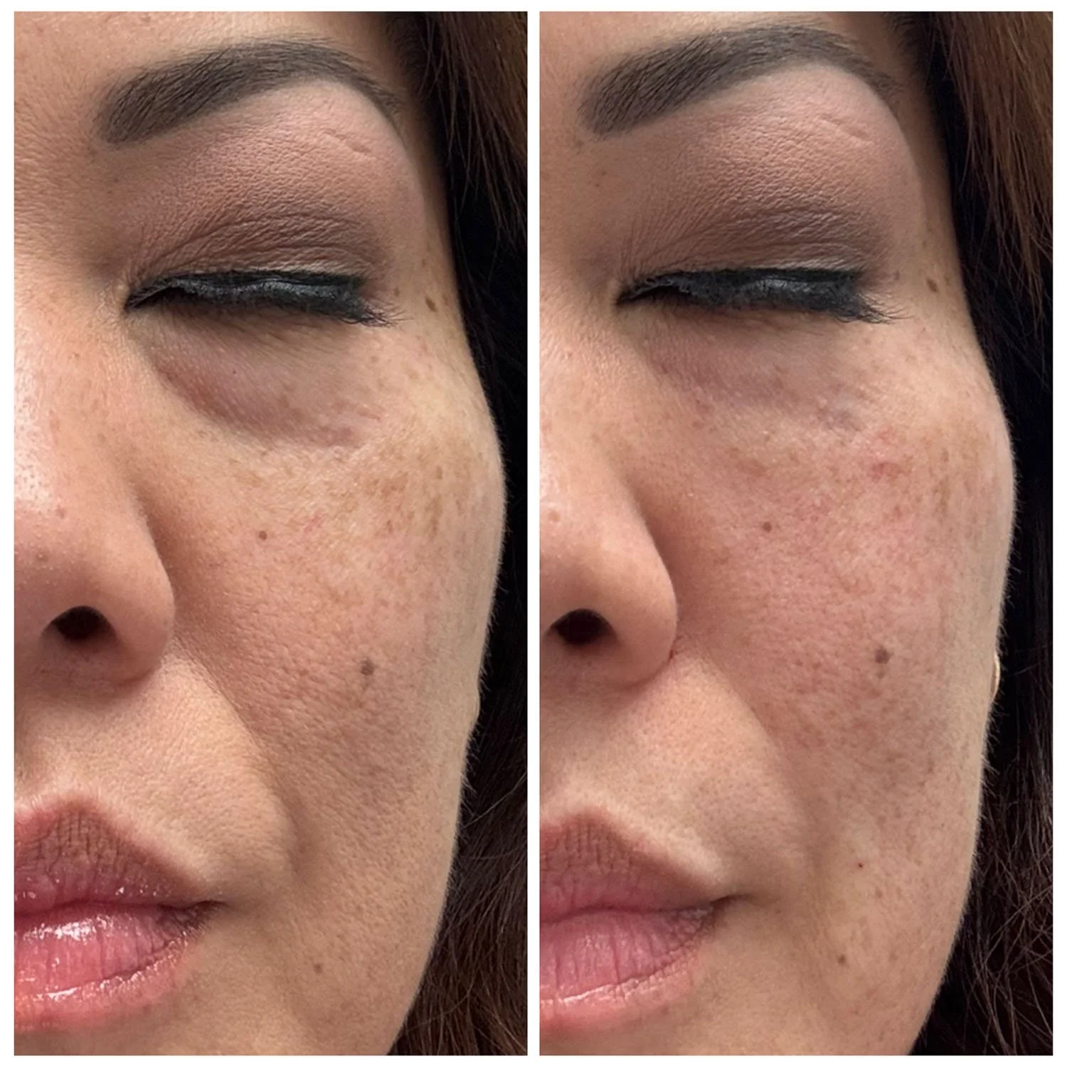 Close-up before and after PRF treatment showing improved skin texture and reduced fine lines from platelet-rich fibrin.