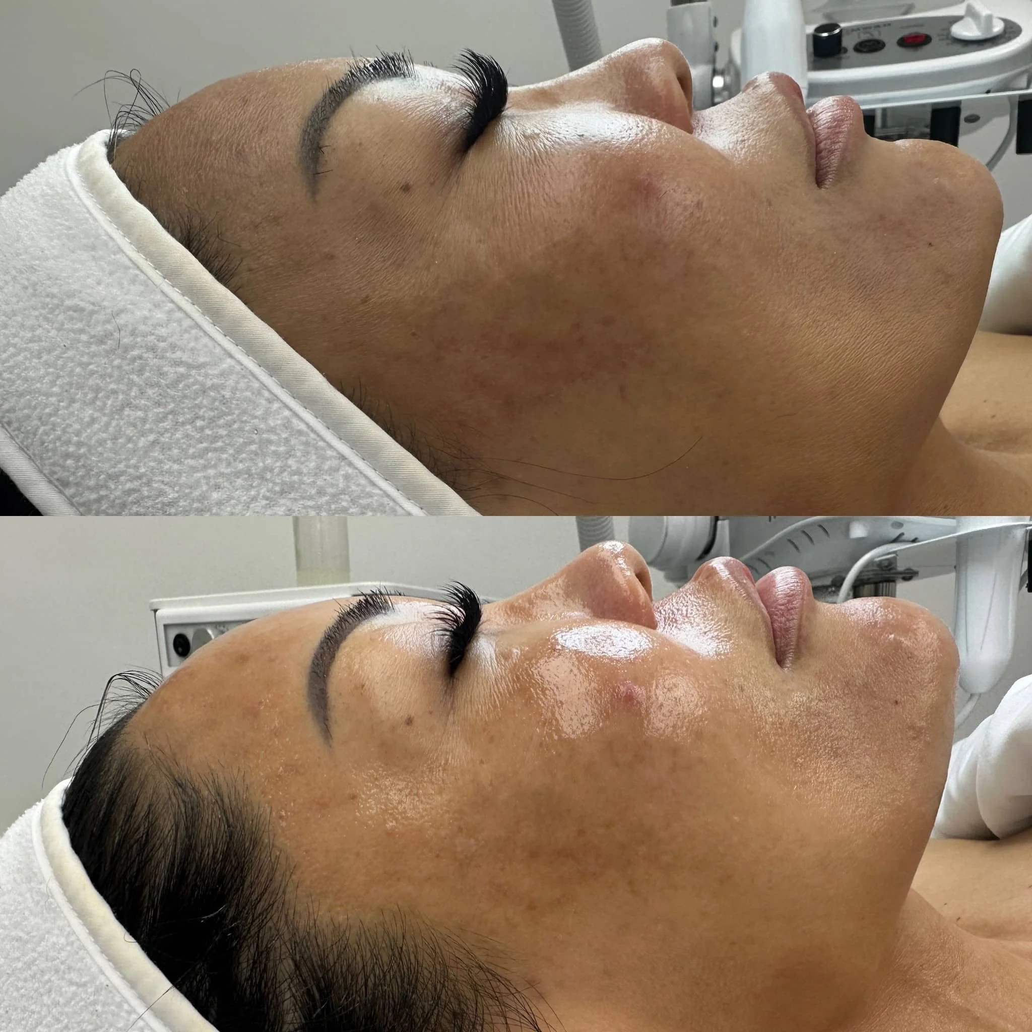 Close-up of a woman lying on a treatment bed in a spa or skincare clinic, receiving a facial treatment, with her eyes closed and a white towel around her head.