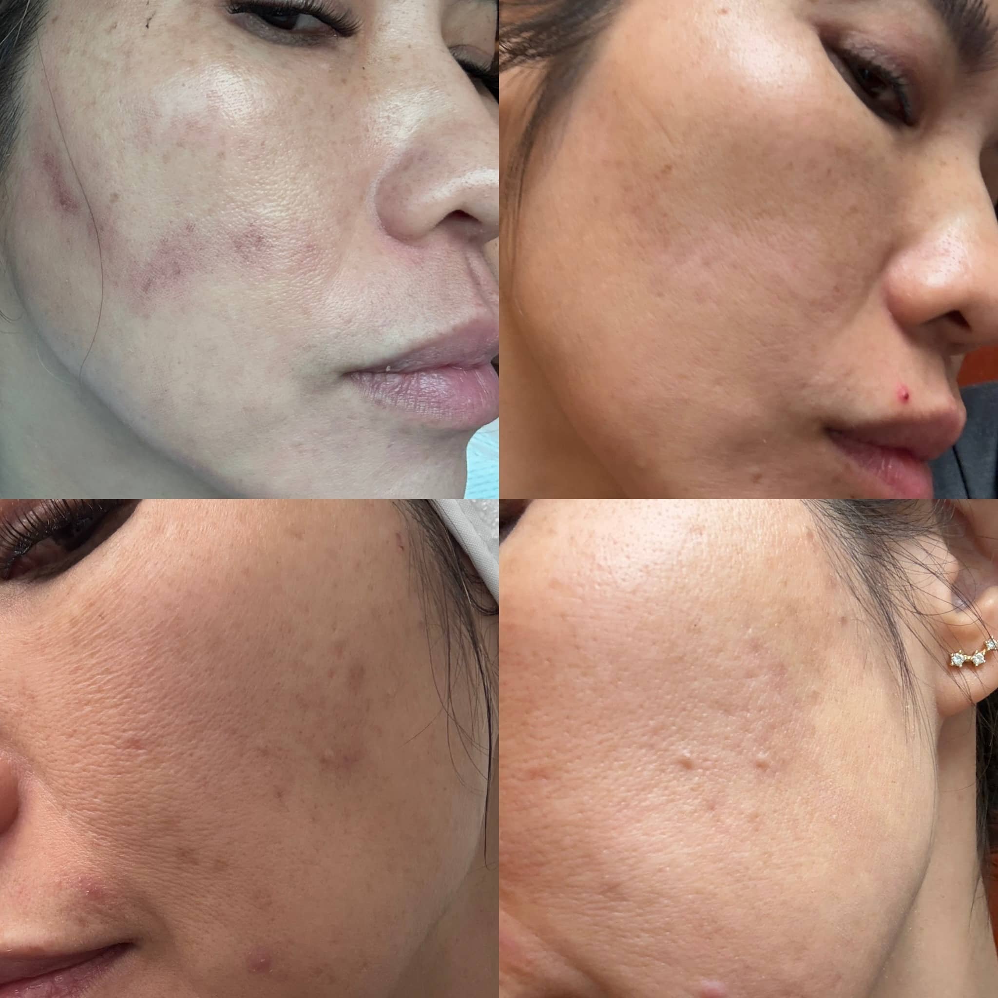 A collage of four close-up images showing before and after results of skin treatment; the top left shows skin with acne scars and uneven texture, the top right shows improvement with smoother skin and less visible scars, the bottom left displays furt