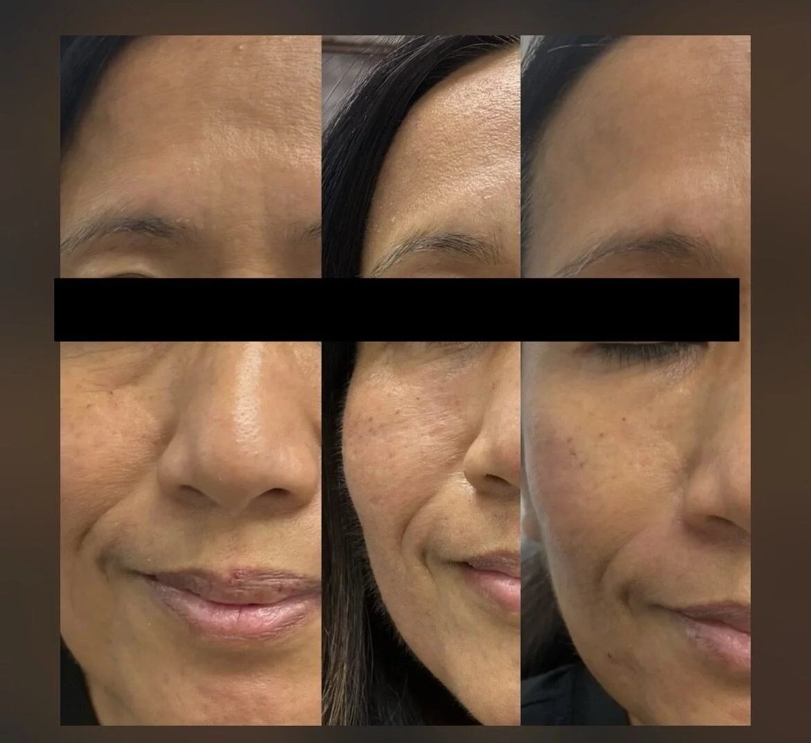 Close-up images of a woman's face showing skin changes before and after skincare or treatment, including a smoother complexion, reduced dark spots, and improved skin texture.