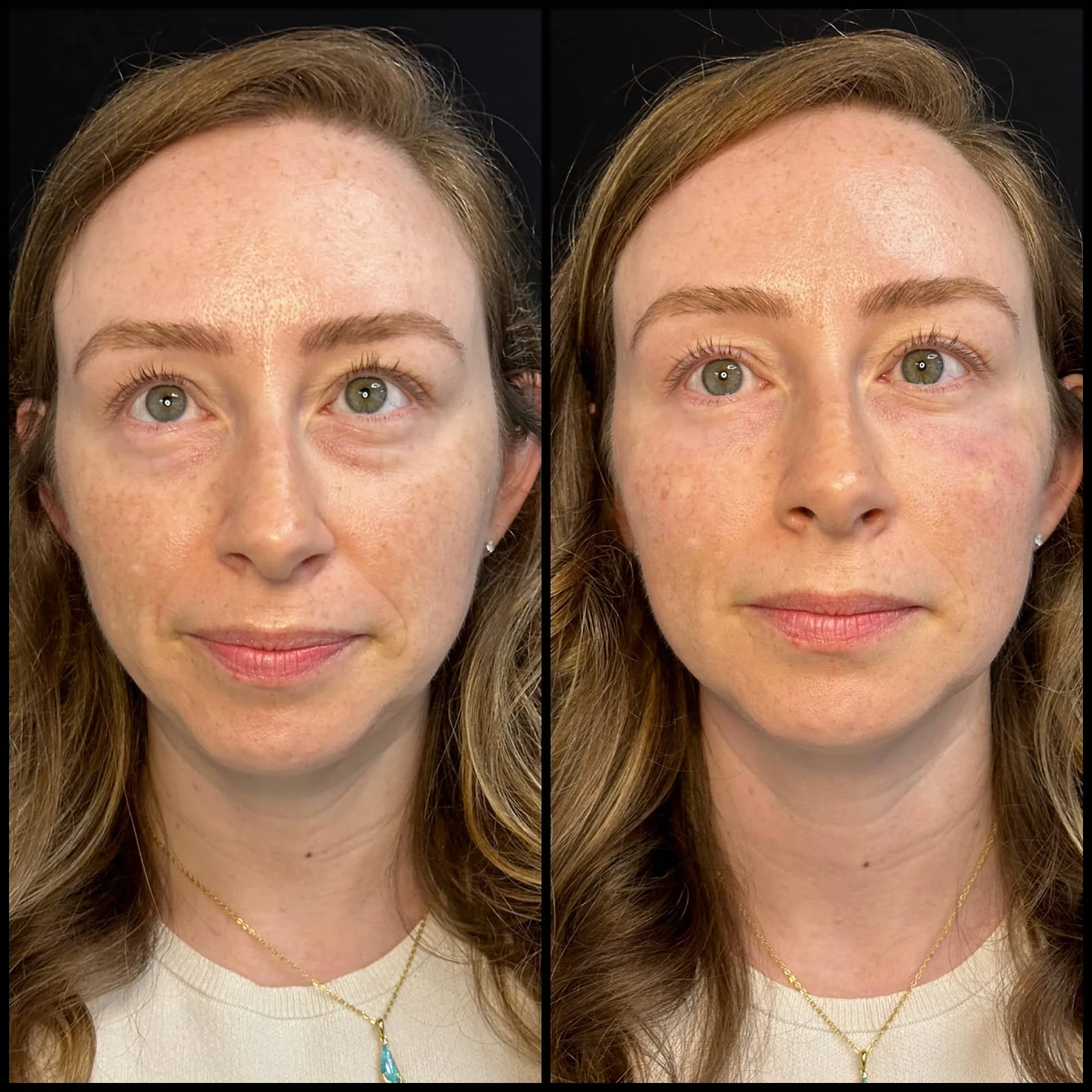 Side-by-side comparison of a woman's face before and after skincare treatment, showing reduced redness, pigmentation, and improved skin texture.