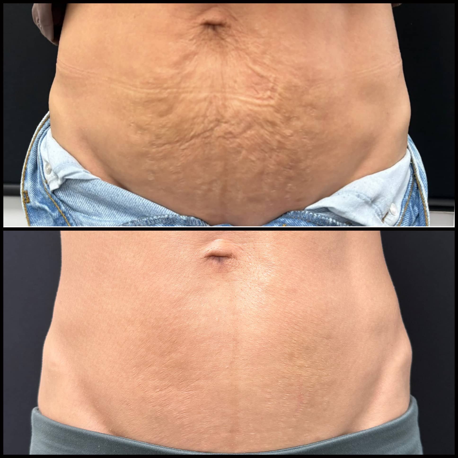 Comparison of a person's abdominal area before and after treatment, showing reduced stretch marks and smoother skin in the after image.