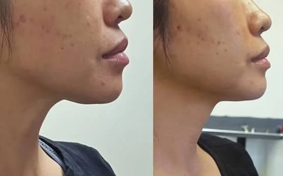 Side-by-side comparison of a person’s face showing improvement in skin condition, with clearer skin and reduced freckles or pigmentation on the right.