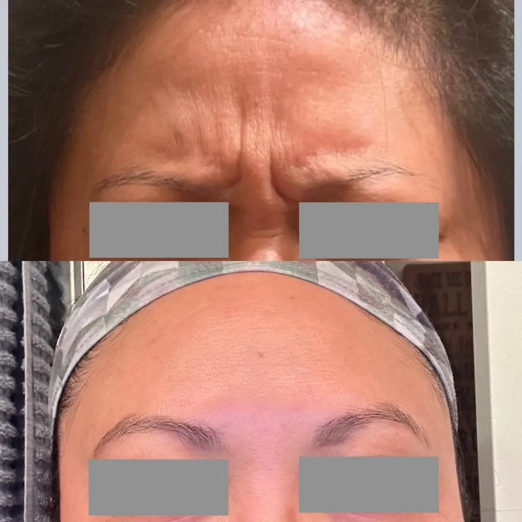 Comparison of a person's forehead before and after cosmetic treatment showing reduced wrinkles and smoother skin.
