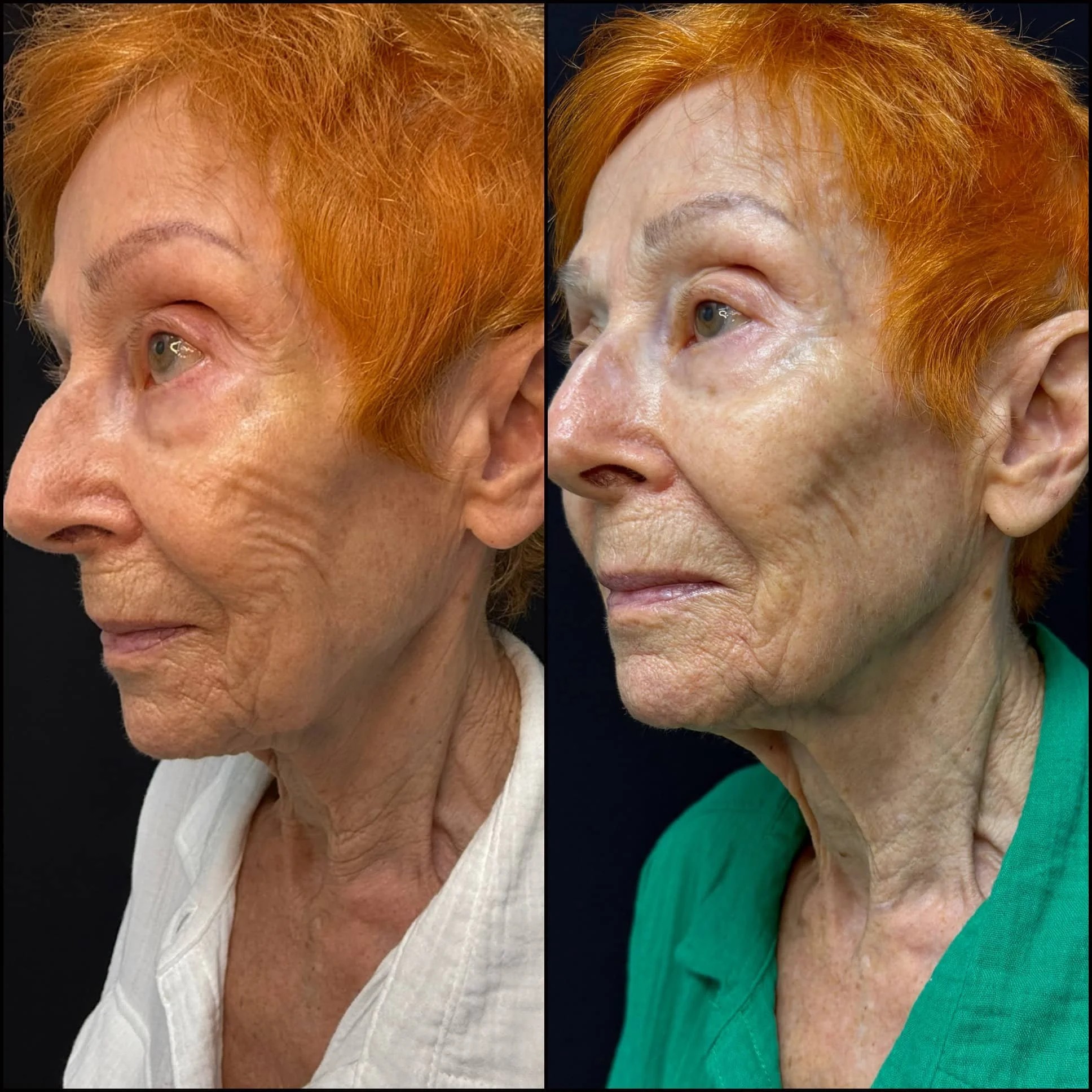 Side-by-side comparison of an elderly woman's face showing before and after skin treatment, with visible improvements in skin texture and appearance.