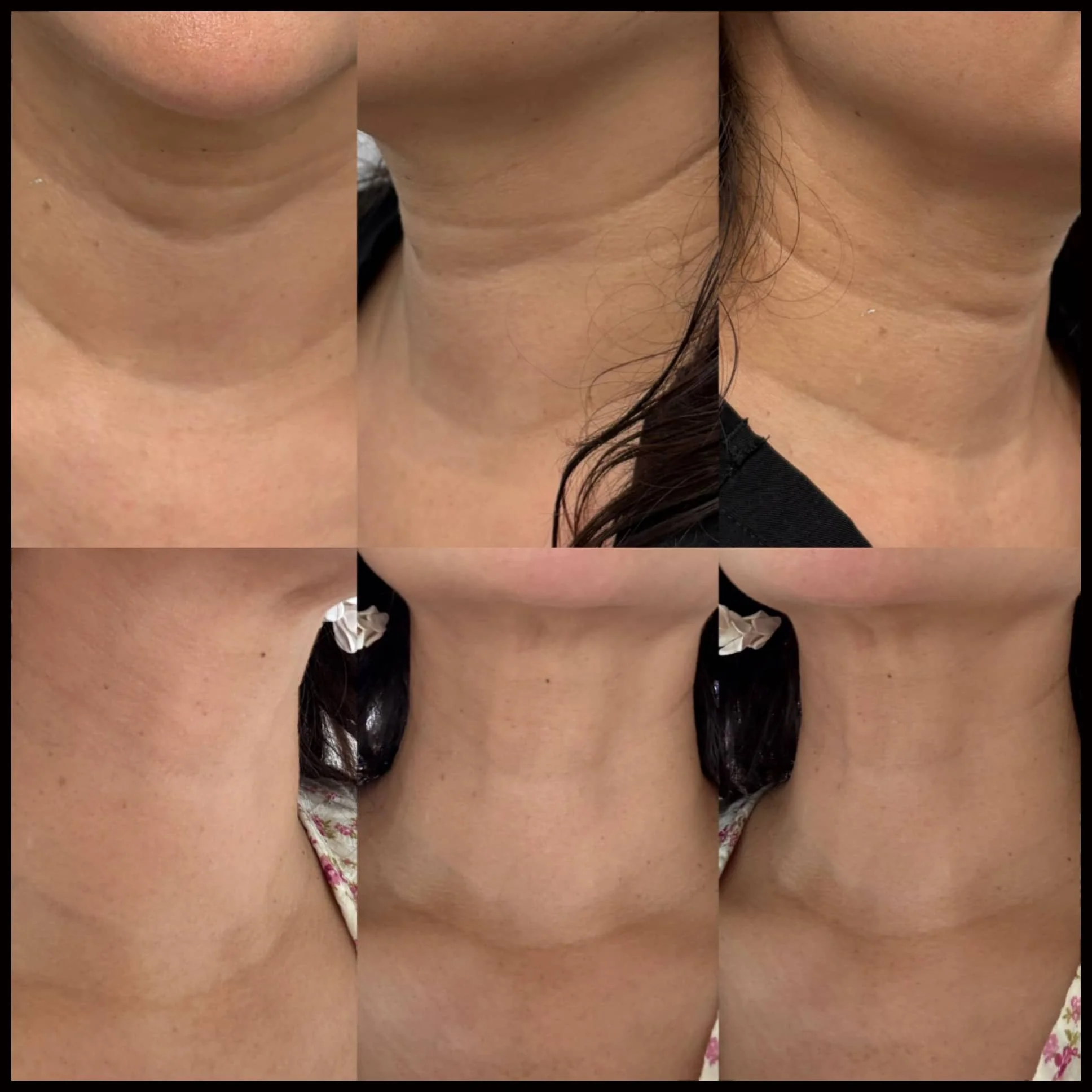 A collage of six close-up images showing the neck area of a woman before and after skin treatment, highlighting improved skin texture and appearance.