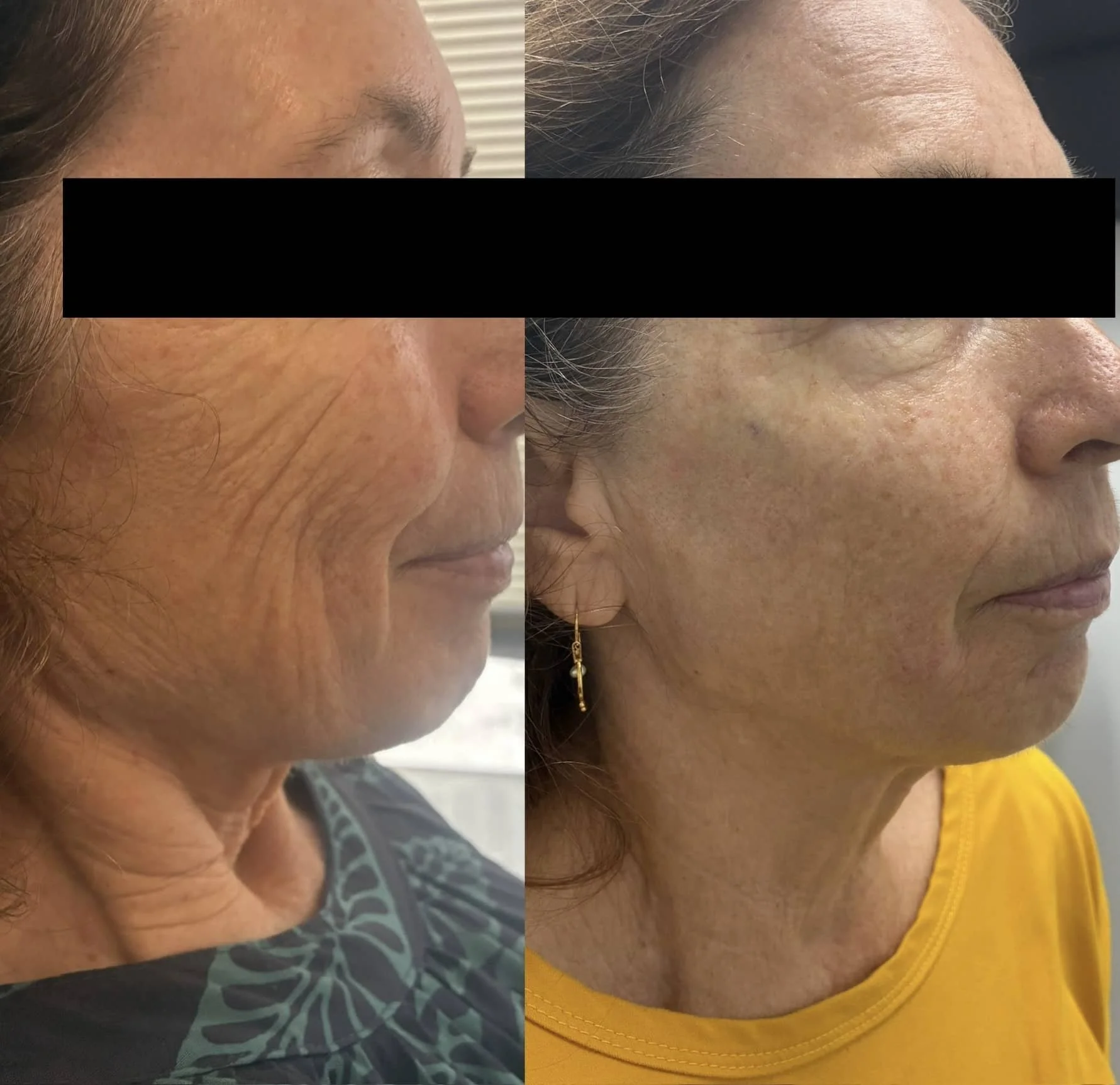 Side-by-side before and after photos of a woman showing facial skin improvements, with visible reduction in wrinkles and blemishes.
