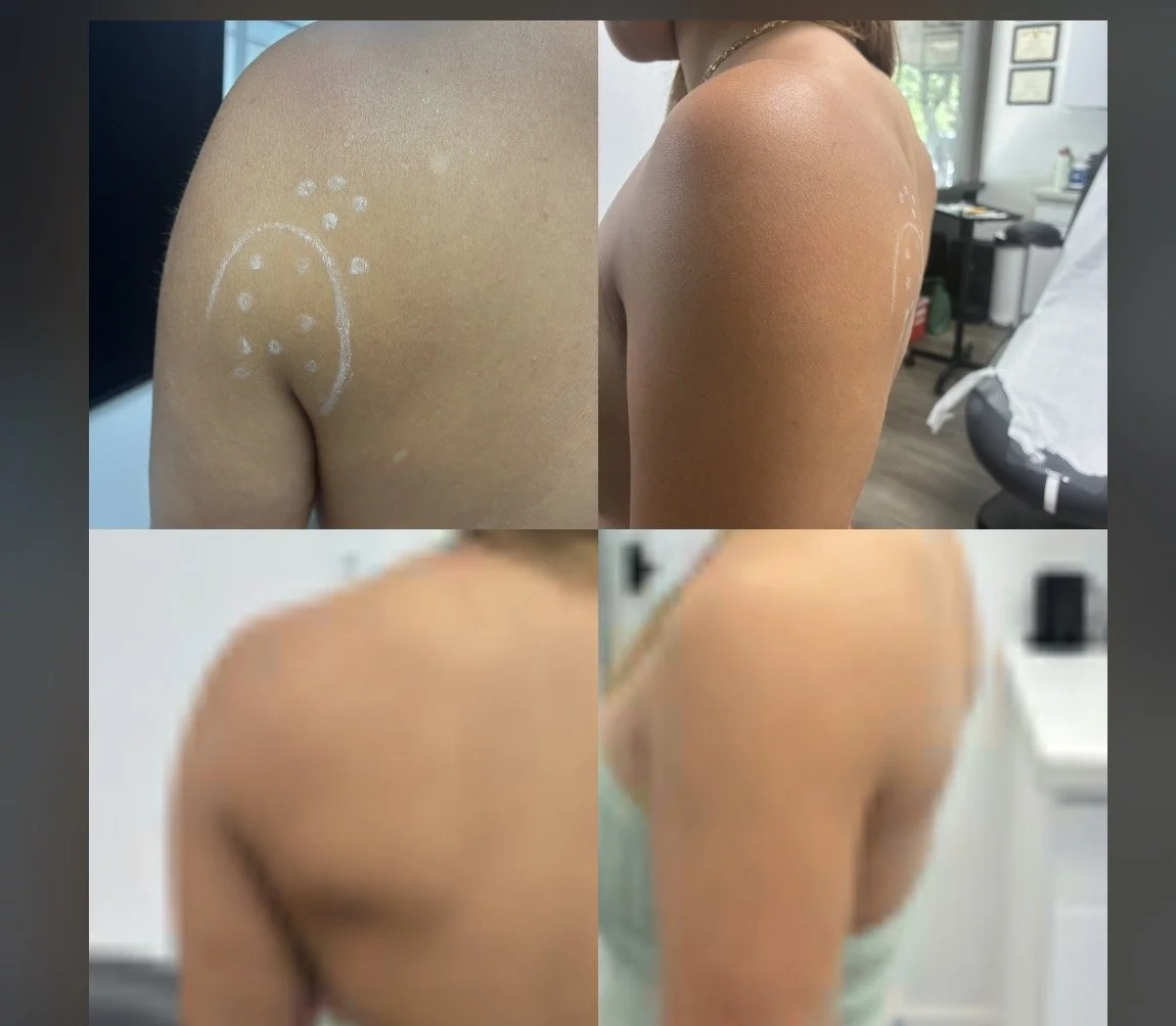 A collage of four images showing a person's shoulder and upper back from different angles, with each photo having a different skin tone and markings.