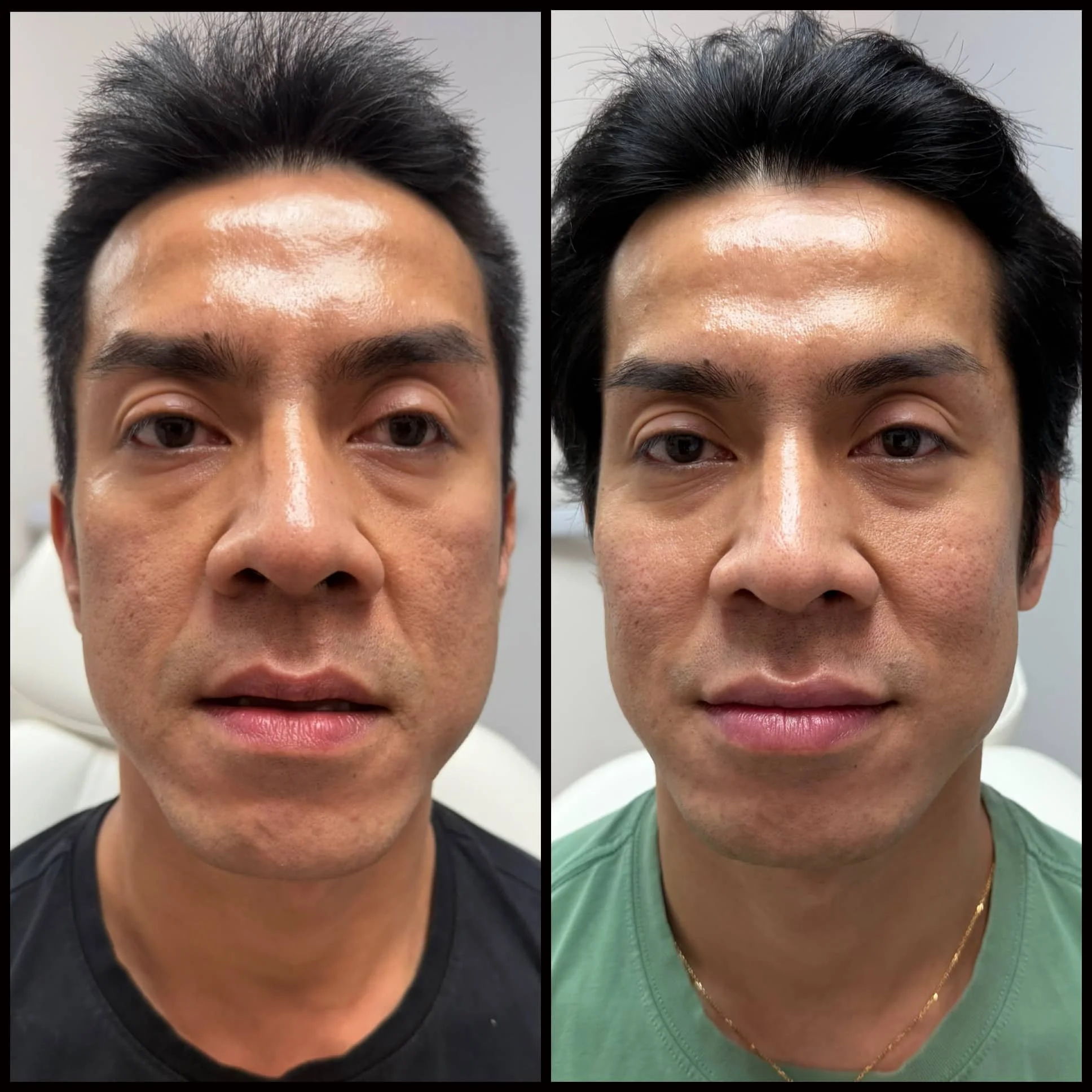 Side-by-side comparison of a man's face before and after skincare treatment, showing improved skin texture and appearance.