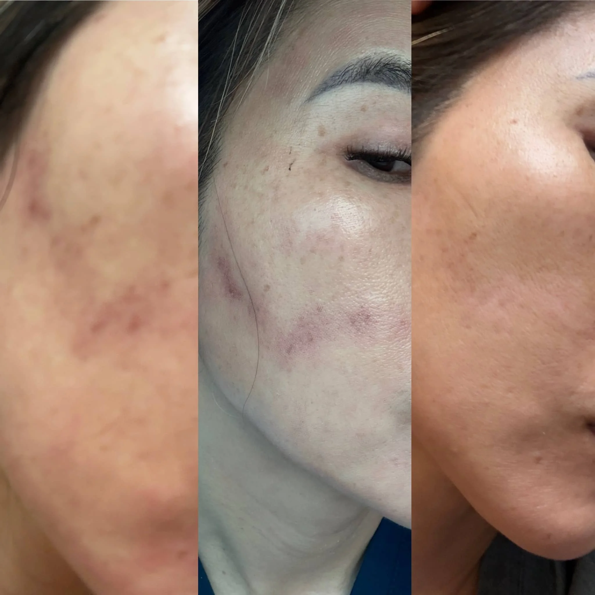 Close-up of a woman's face showing acne scars and skin imperfections at different stages of skincare or treatment.