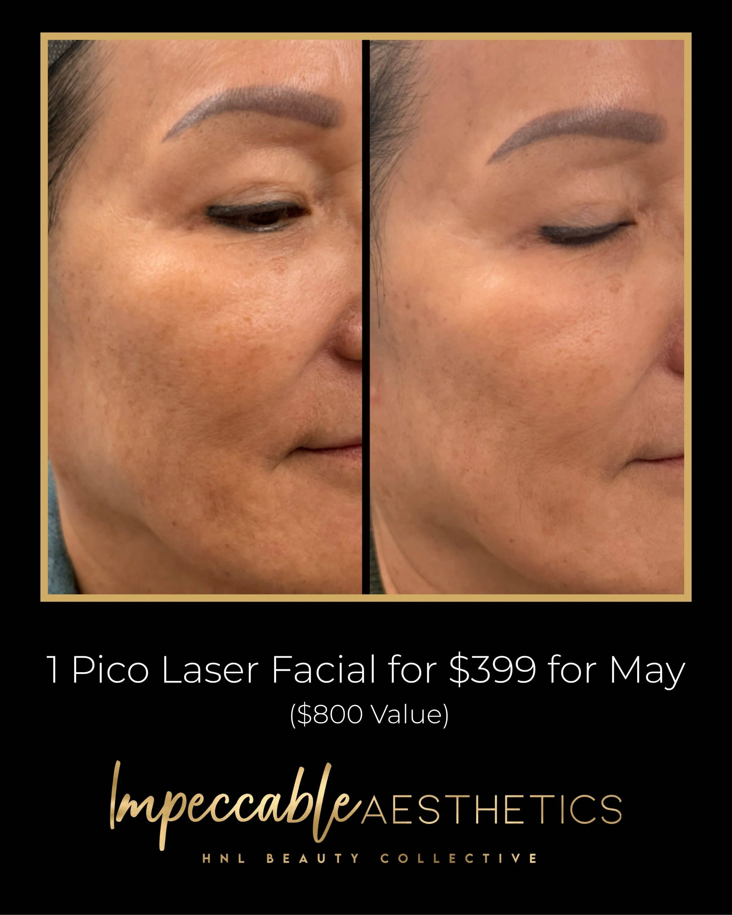 The side of a woman's face before and after getting a Pico Laser facial from Impeccable Aesthetics.