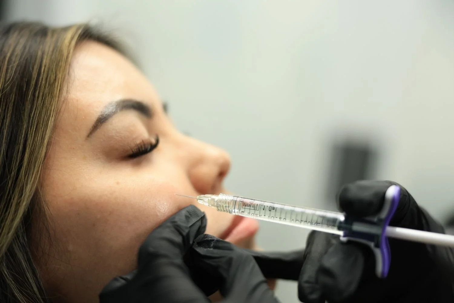 Close-up of a clear filler syringe with a purple grip used on a woman's lower cheek area.