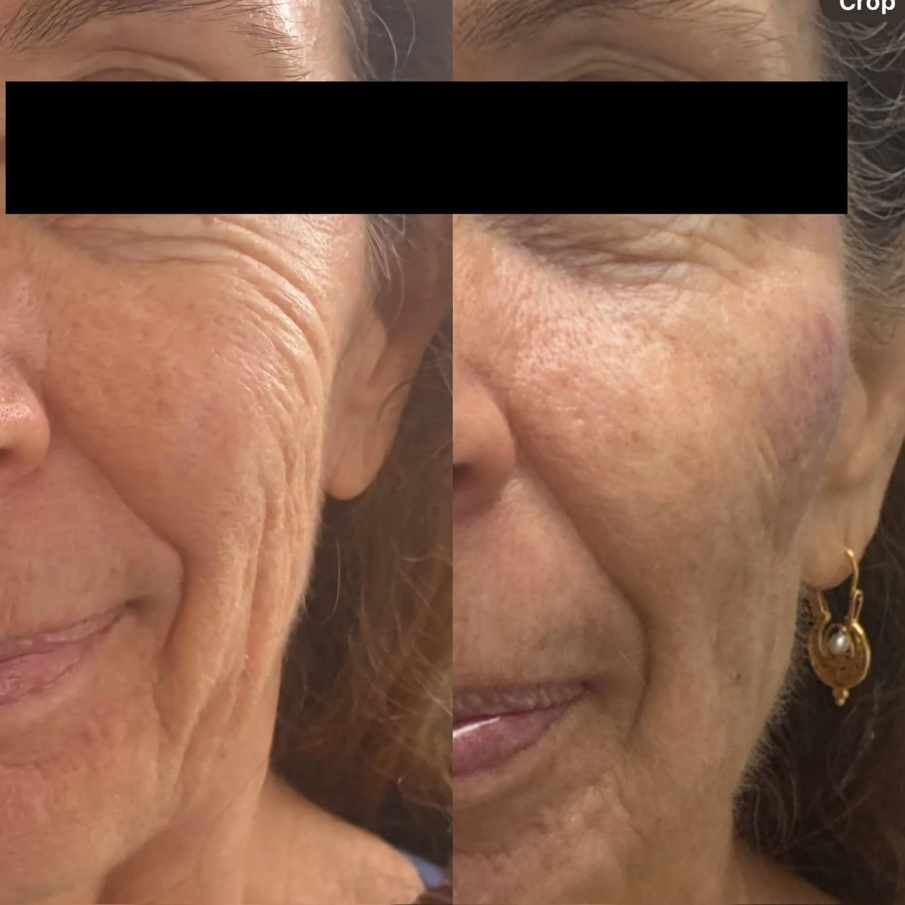 Close-up of an elderly woman's face showing before and after images of skincare or cosmetic treatment.