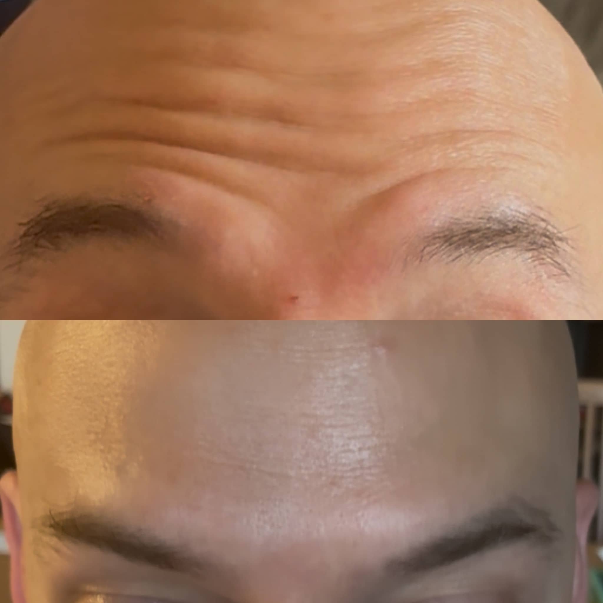 Close-up images of the foreheads of two individuals, showing skin textures and facial features.