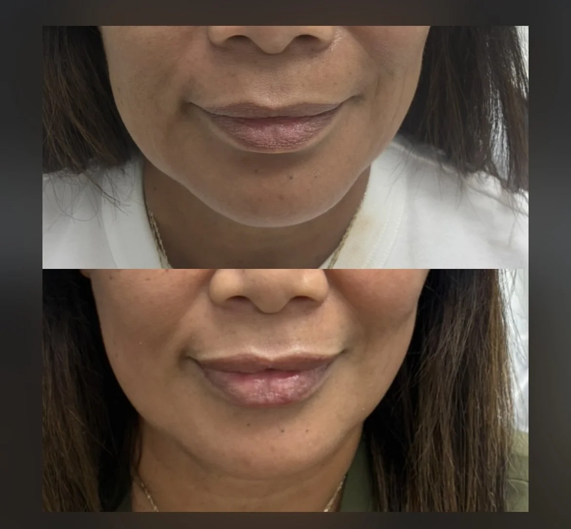 Comparison of a woman's face above and below, showing the area around her lips, with the lower image displaying smoother skin and fuller lips.
