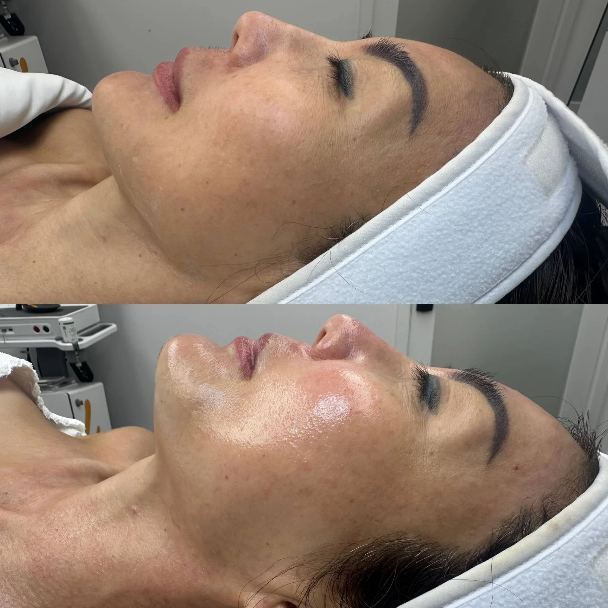 Side view of a woman lying in a medical setting before and after skincare treatment, with visible improvements in skin texture and glow.