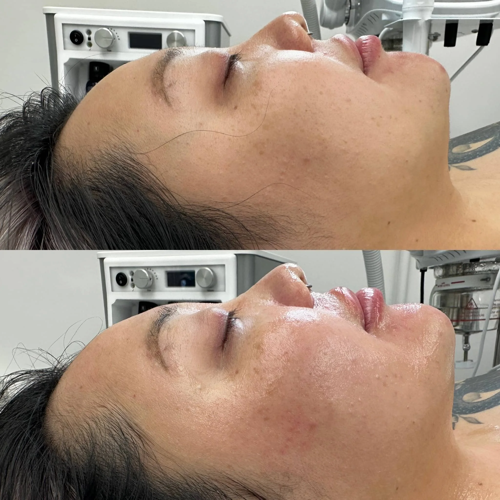 Side-by-side comparison of a woman's face before and after skincare treatment, showing improved skin texture and hydration.