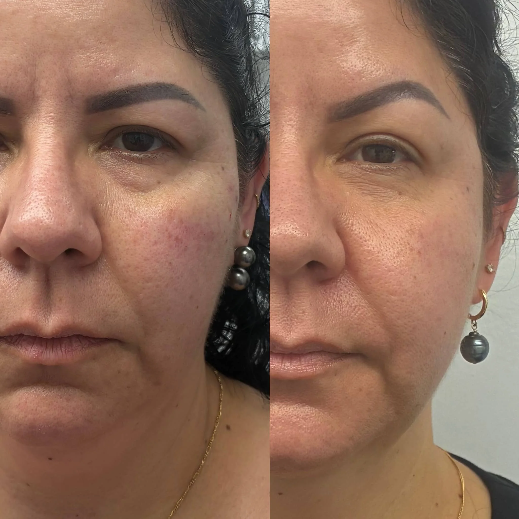Side-by-side close-up images of a woman's face before and after skin treatment, showing reduced redness and improved skin texture.