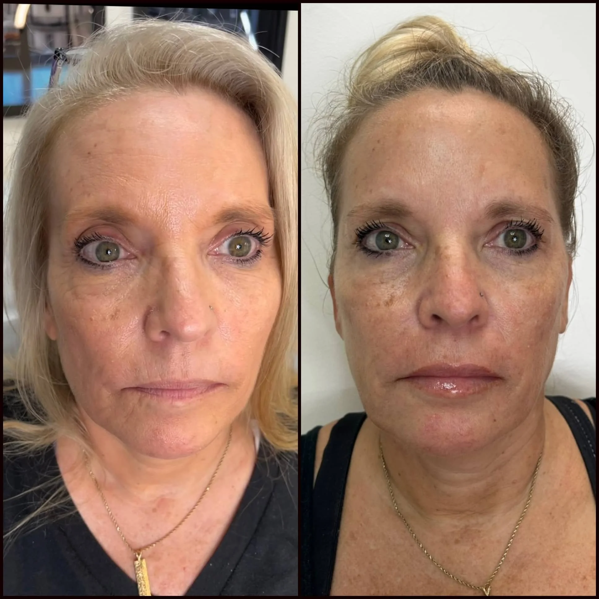 Comparison photo of a woman before and after skincare or cosmetic treatment, showing improved skin texture and tone.