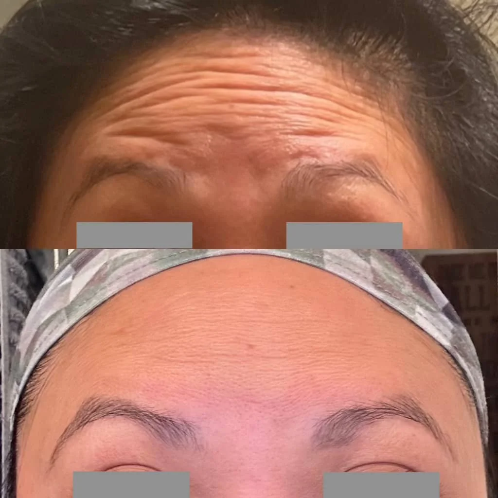 Comparison of a person's forehead showing wrinkles before and after a cosmetic treatment, with the top image showing prominent forehead lines and the bottom image showing smooth skin.