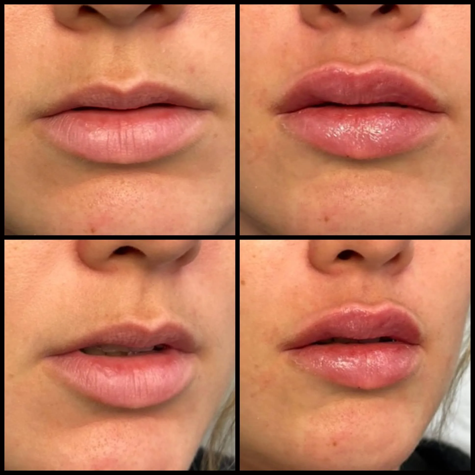 A collage of four close-up images of lips, showing before and after lip enhancement or gloss application.