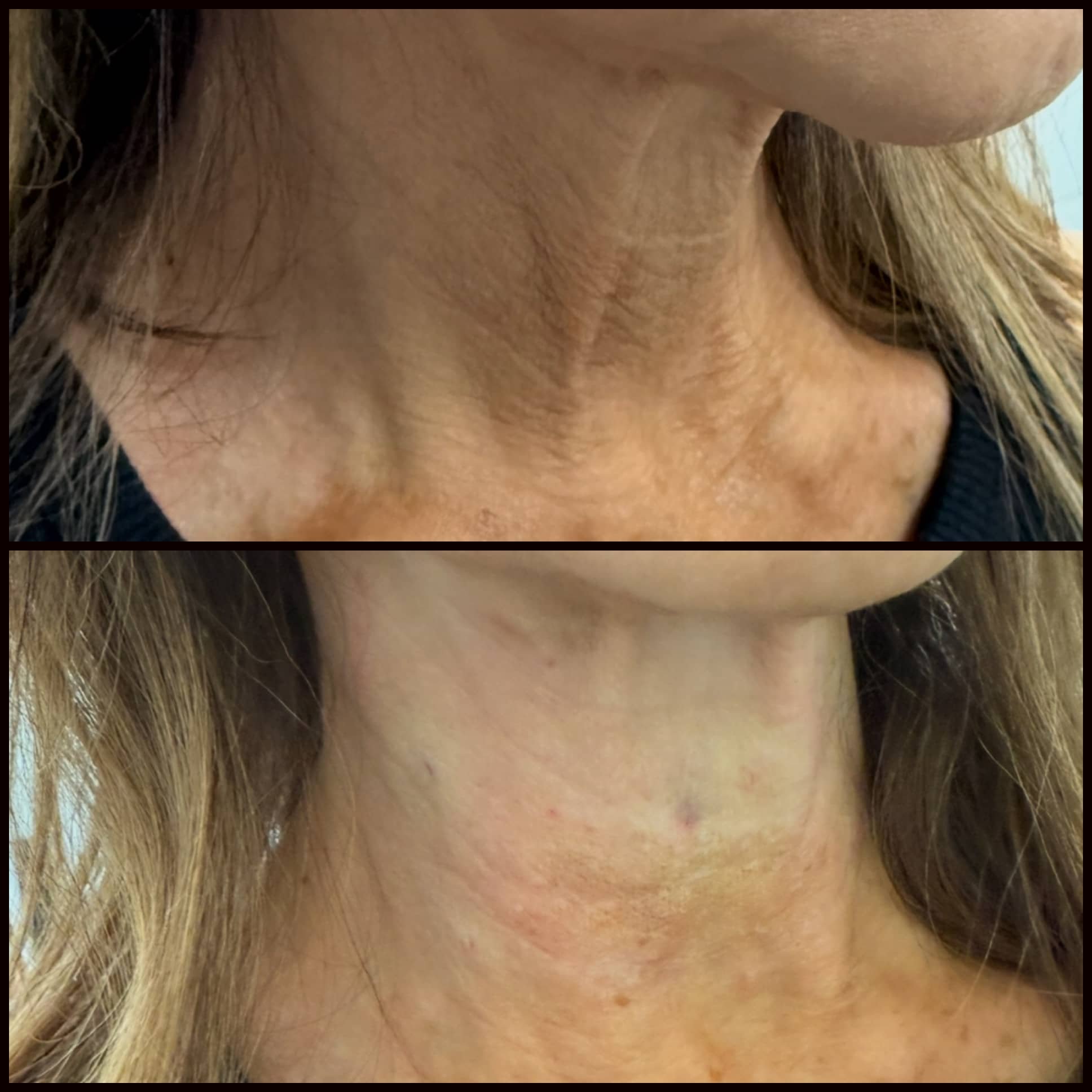 Comparison of a woman's neck before and after skincare treatment; top shows skin with wrinkles and uneven tone, bottom shows smoother skin with reduced wrinkles and more even tone.