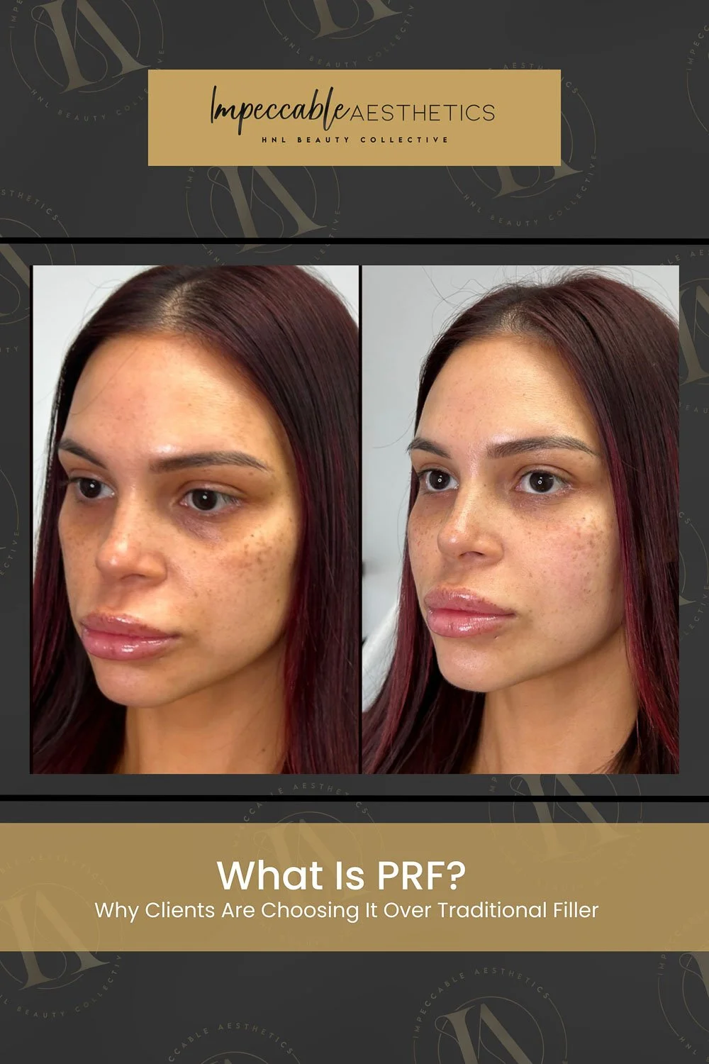 Pinterest graphic explaining what PRF is and why clients choose platelet-rich fibrin over traditional filler at Impeccable Aesthetics.